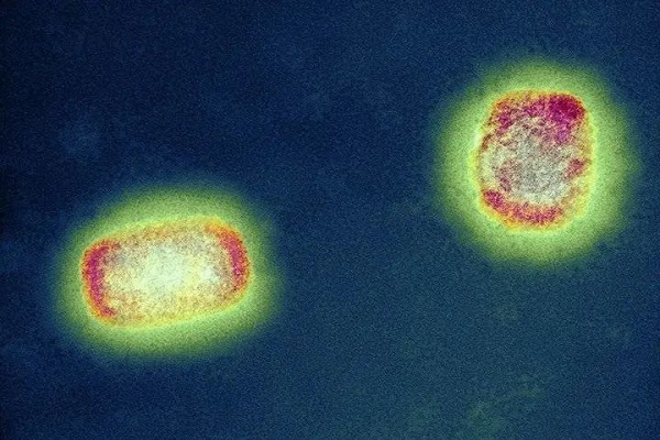 Prueba rápida de antígeno: ¿Monkeopox, descuidado por el mundo, se convertirá en la próxima enfermedad súper infecciosa?